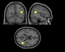 Figure 2. The location of temporal lobe differences in brain function in when women weight-recovered from anorexia nervosa view emotional faces, versus when women without an eating disorder.