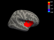 Figure 3. Area of difference in brain structure young women with anorexia nervosa (temporal lobe).