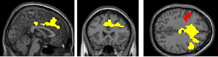Areas of the brain that work differently when looking at happy faces in non-underweight individuals with anorexia nervosa.